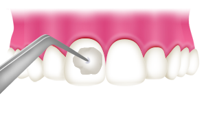 虫歯の治療