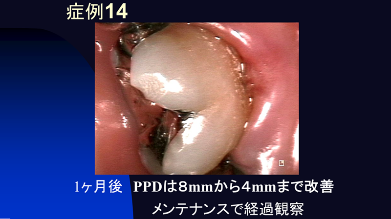 世界初、ラジカル酸素を活用した特殊レーザー治療