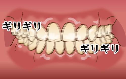 顎関節症になる原因