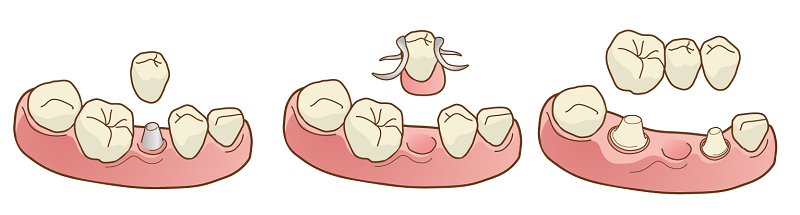 インプラントと入れ歯＆ブリッジの違い