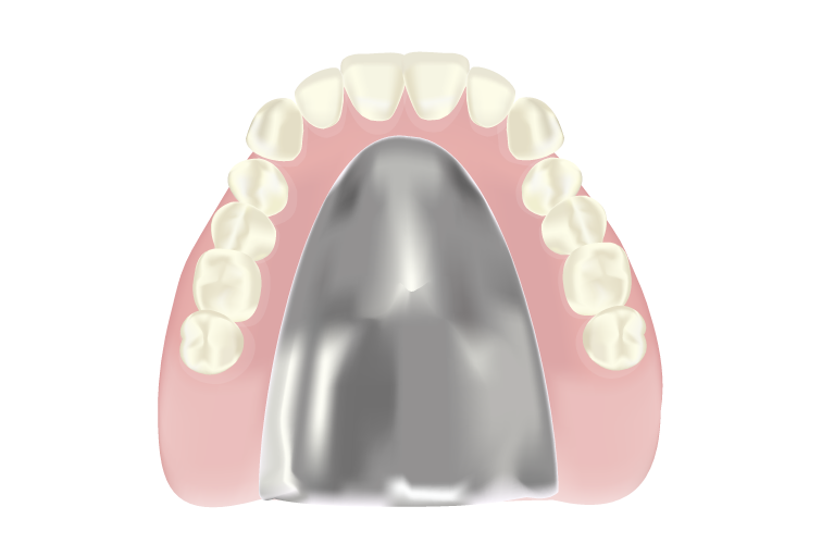 金属床義歯
