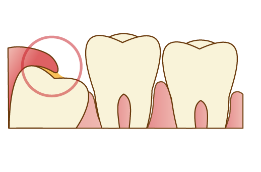 親知らずを抜歯した方が良いケース