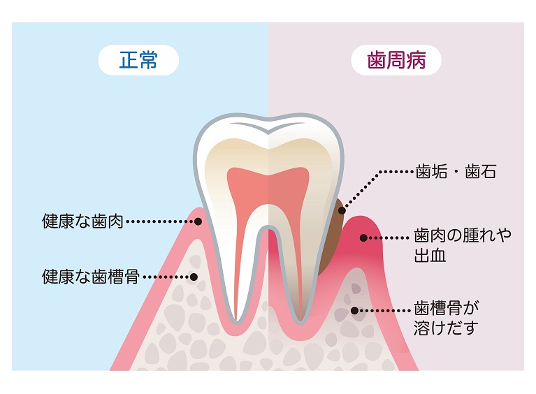 歯周病の危険性